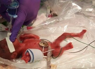 Saybie, considerada a mais pequena bebé do mundo, nasceu com o peso de uma maçã