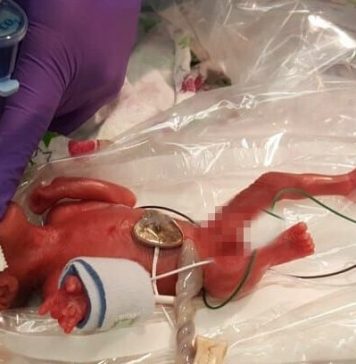 Saybie, considerada a mais pequena bebé do mundo, nasceu com o peso de uma maçã