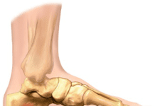 Click Saúde & Bem Estar – O que é a fascite plantar? Como se identifica? Quais as soluções?