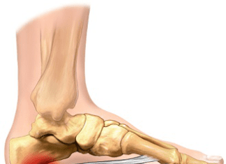 Click Saúde & Bem Estar – O que é a fascite plantar? Como se identifica? Quais as soluções?