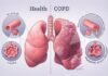 Fisioterapia Respiratória