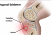 Doença de Osgood-Schlatter