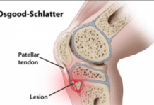 Doença de Osgood-Schlatter