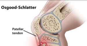 Doença de Osgood-Schlatter