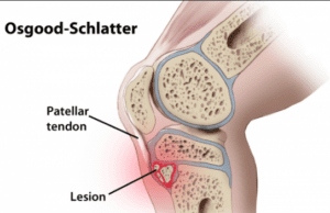 imagem Osgood-Schlatter