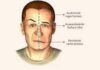 Paralisia Facial Periférica