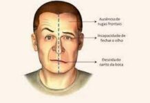 Paralisia Facial Periférica