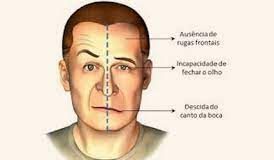 Paralisia Facial Periférica