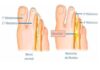 Neuroma