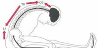 Tensão Neural Adversa – A importância da mobilização neural