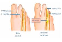 Neuroma