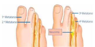 Neuroma