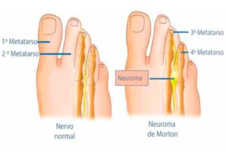 Neuroma