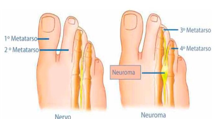 Neuroma