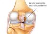 CLICK SAÚDE & BEM ESTAR | Rotura do Ligamento Cruzado Anterior: Operar ou não operar?