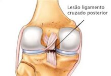 CLICK SAÚDE & BEM ESTAR | Rotura do Ligamento Cruzado Anterior: Operar ou não operar?