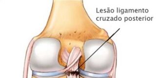 CLICK SAÚDE & BEM ESTAR | Rotura do Ligamento Cruzado Anterior: Operar ou não operar?