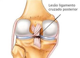 CLICK SAÚDE & BEM ESTAR | Rotura do Ligamento Cruzado Anterior: Operar ou não operar?