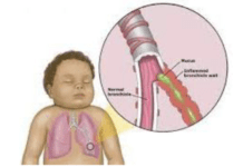 Click Saúde & Bem Estar | Bronquiolite Aguda