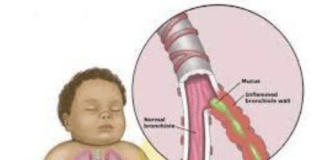 Click Saúde & Bem Estar | Bronquiolite Aguda