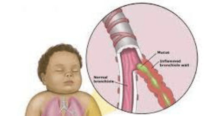 Click Saúde & Bem Estar | Bronquiolite Aguda
