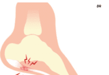 Click Saúde & Bem Estar | Fascite Plantar