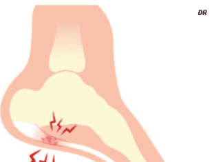 Click Saúde & Bem Estar | Fascite Plantar