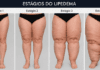 Click Saúde & Bem Estar | O que é o Lipedema?