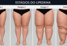 Click Saúde & Bem Estar | O que é o Lipedema?