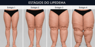 Click Saúde & Bem Estar | O que é o Lipedema?