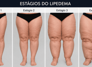 Click Saúde & Bem Estar | O que é o Lipedema?